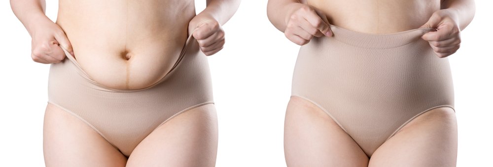 Understanding the Importance of a High-Quality Faja After Liposuction and BBL